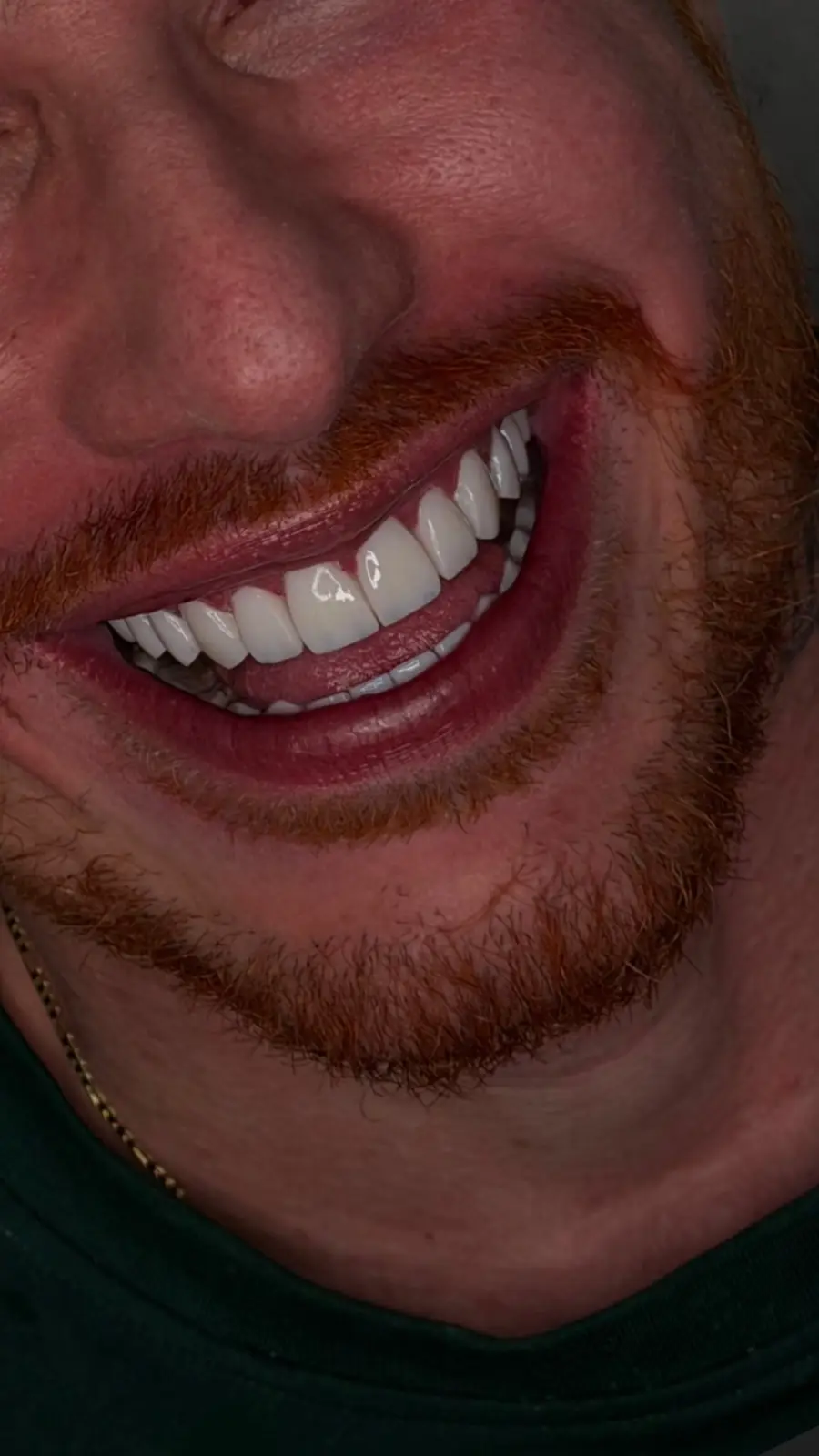 Sorriso com lentes em resina